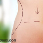 کلینیک عمل لیپوماتیک در تهران